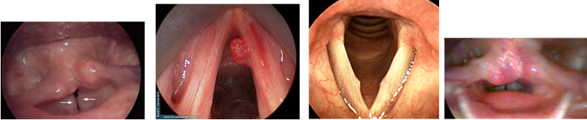 <p>Name all 4 hyperfunctional voice disorders </p>