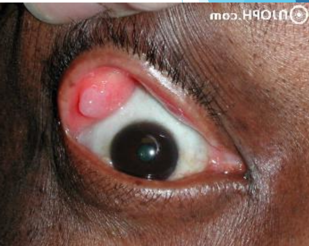 <p>Lacrimal ductal cyst</p><p>Swelling due to retention of lacrimal secretion due to blockage</p>