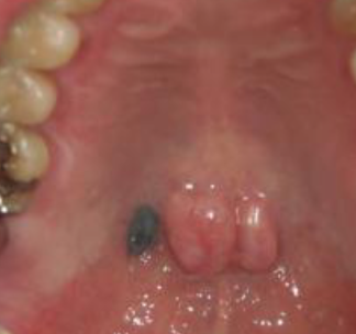 <p>what is the most likely diagnosis </p>
