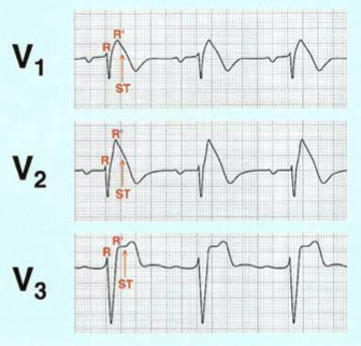 <p>may be intermittent and revealed by conditions (i.e., fever, ischemia, medications, hypokalemia)</p><p>- pseudo RBBB</p><p>- coved ST segment elevation &gt;2 mm in right chest leads</p><p>- T-wave inversion in right chest leads</p>