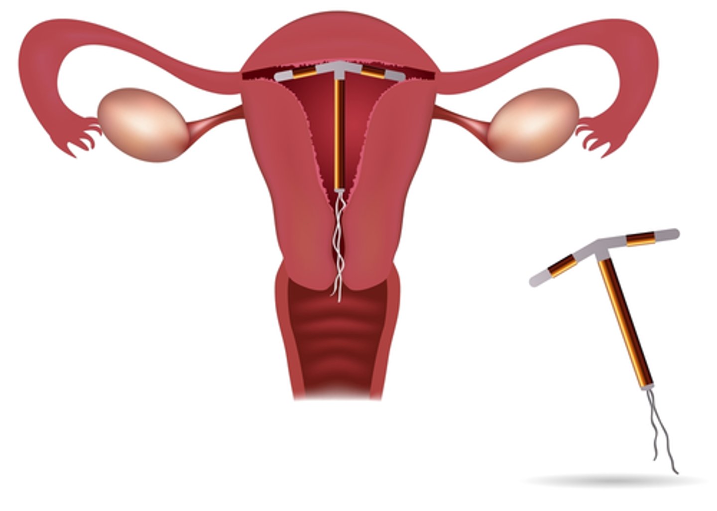 <p>Placed in the uterus by a physician prevents egg and sperm from fusing</p><p>-Non-hormonal</p>