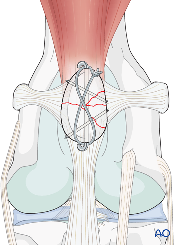 <ol><li><p>Undisplaced fissure fracture: Wire through quadriceps tendon and patellar ligament. Wires tightened.</p></li><li><p>Transverse fracture: Kirschner wire and tension band wire, second wire in larger dogs.</p></li><li><p>Multi-fragmentary fracture: Kirschner wire and tension band wire</p></li></ol><p></p>