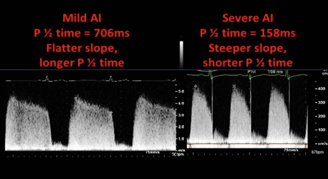 <p>AI with a pressure half time of 150 ms </p>