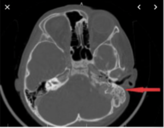 <p>In a mastoid air cell CT positive for mastoiditis, what would we find?</p>