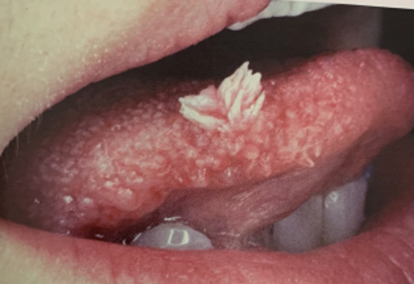 <p>Hint: common, benign, HPV-induced proliferation of stratified squamous epithelium</p>