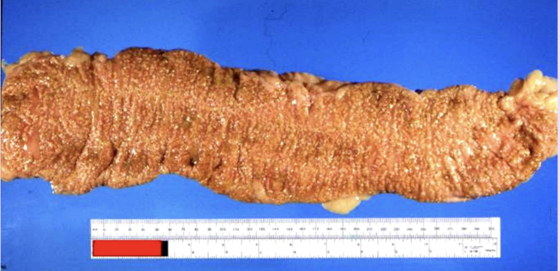 <p>Pseudomembranous inflammation (colitis)</p>