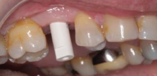 <p>How do you create a digital impression using an intraoral scanner?</p>