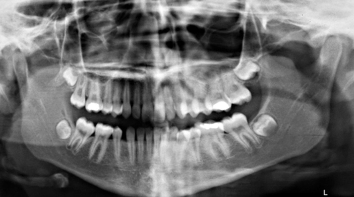 <p>What light needs to repositioned to fix this image?</p><p>A) mid-sagittal</p><p>B) Frankfort plane</p><p>C) focal trough</p>