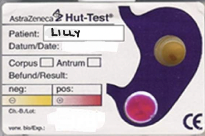 <p><span><strong><span>Lilly is negative for a ulcer at the body of the stomach just under the antrum however is positive for ulcer at the base of the stomach just before the pylorus.</span></strong></span></p>