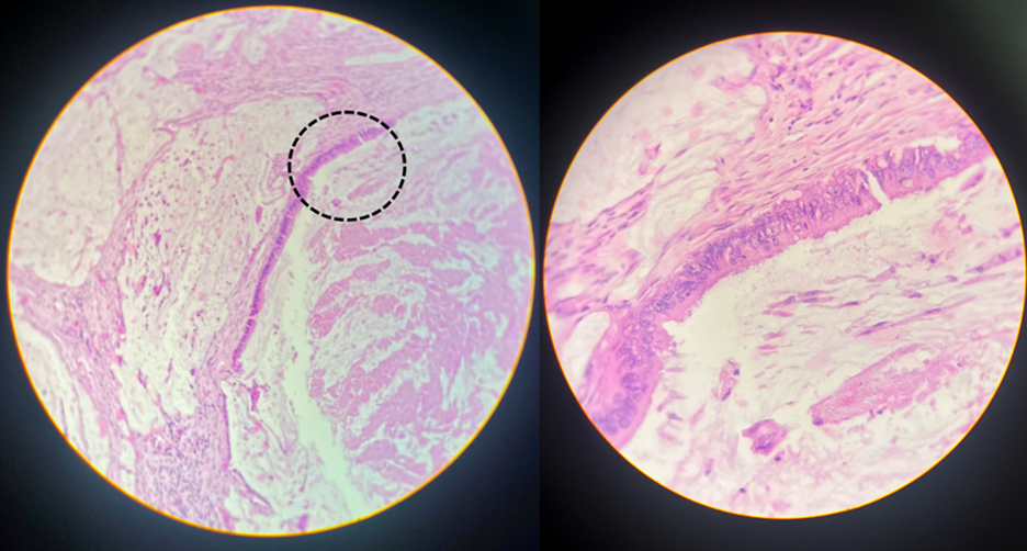 <p>Microscopic examination of H&amp;E-stained sections from a retroperitoneal lymph node from a 59-year-old male with abdominal pain, rectal bleeding and multiple abdominal masses on CT reveals the results shown in the accompanying image. The region indicated by the dashed circle is shown at higher magnification to the right.</p><p>What is the most likely diagnosis?</p>