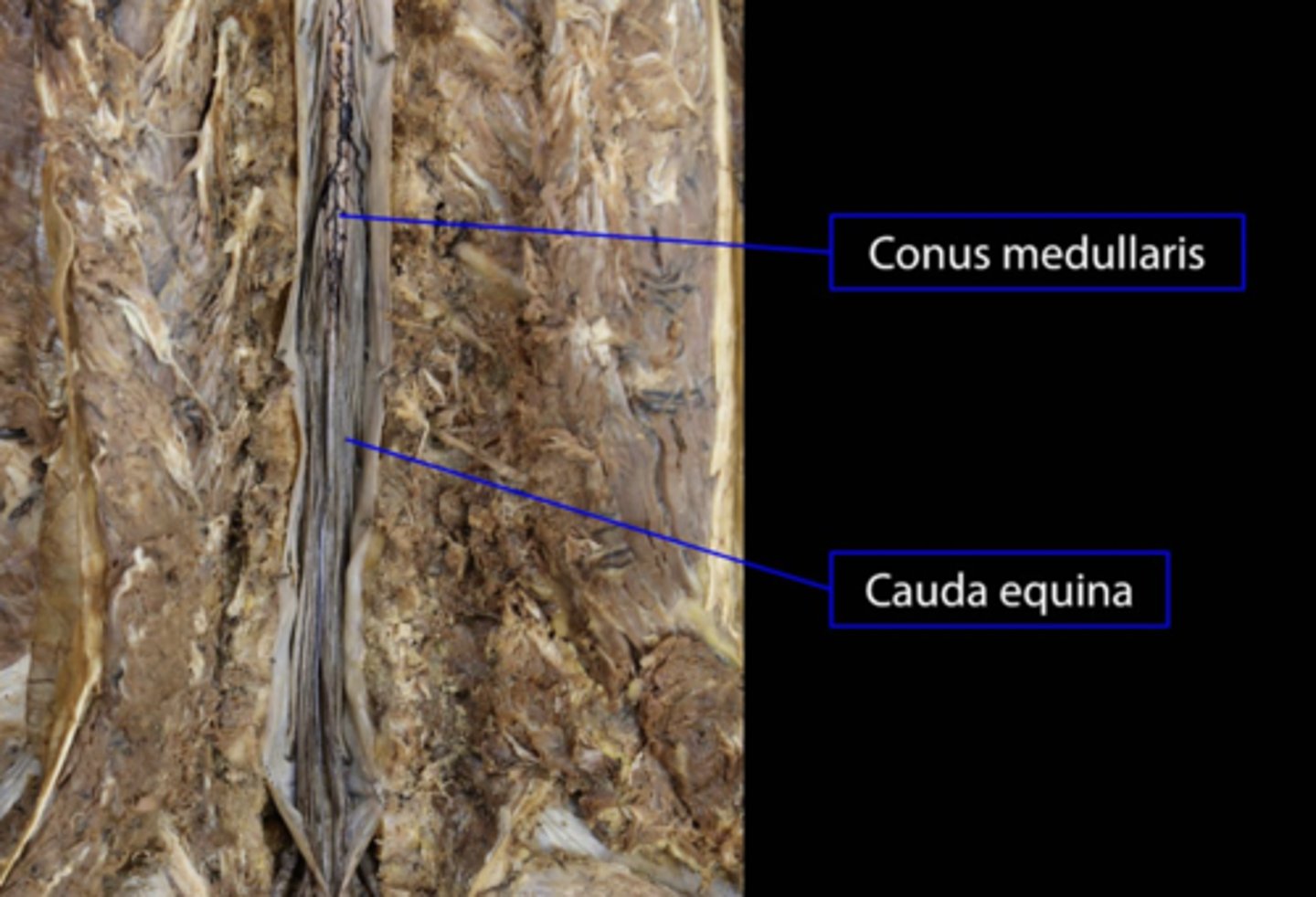 <p>"horse tail" bundle of nerves at end of spinal cord</p>