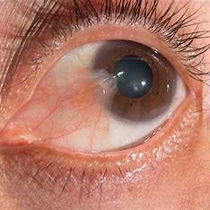 <p>= bulbar conjunctiva overgrows towards the center of the cornea</p><ul><li><p>may obstruct vision if it covers the pupil</p></li><li><p>occurs from chronic exposure to hot, dry, sandy climates</p></li></ul>