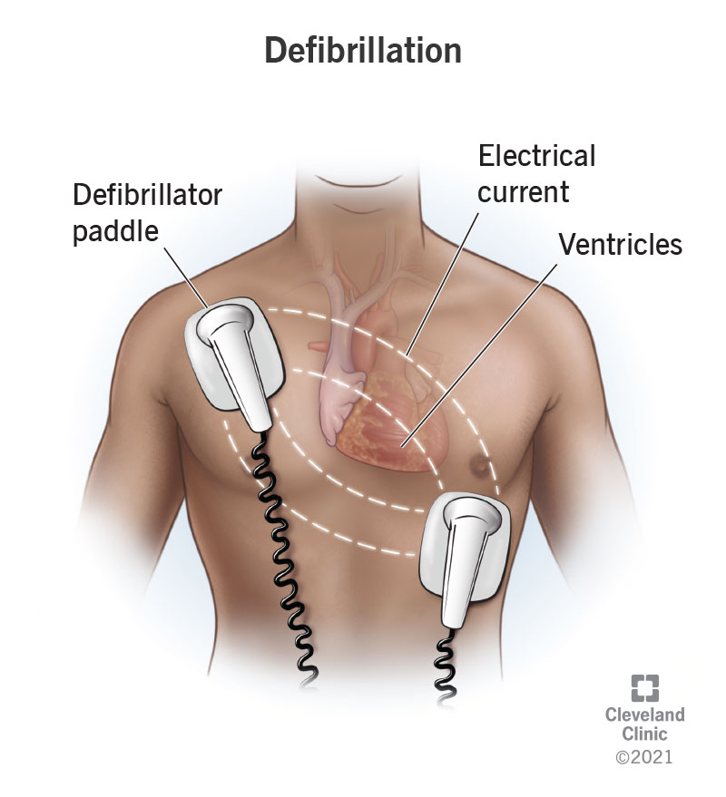 <p>Used to discharge a strong electrical current into the patients heart through electrode paddles held against the bare chest wall.</p>