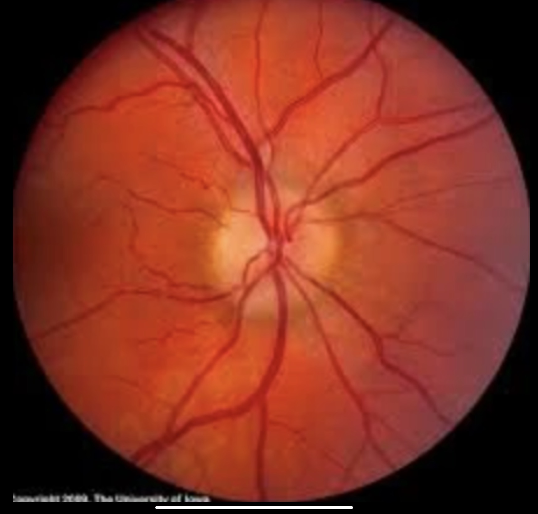 <ul><li><p>Cefalea (matutina)</p></li><li><p>Nauseas y vómitos en escopetazo</p></li><li><p>Edema de papila (papiloedema) (Foto)</p></li></ul><p></p>