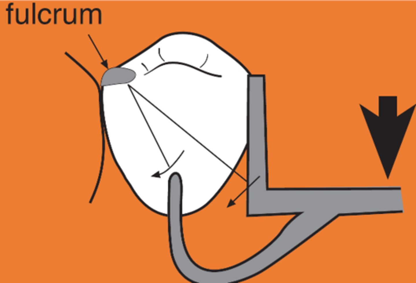 <p>Mesial occlusal rest on tooth adjacent to distal edentulous segment</p><p>• Rotation: retentive tip, proximal plate</p><p>• Move mostly down (and forward), releasing clasp from tooth</p>