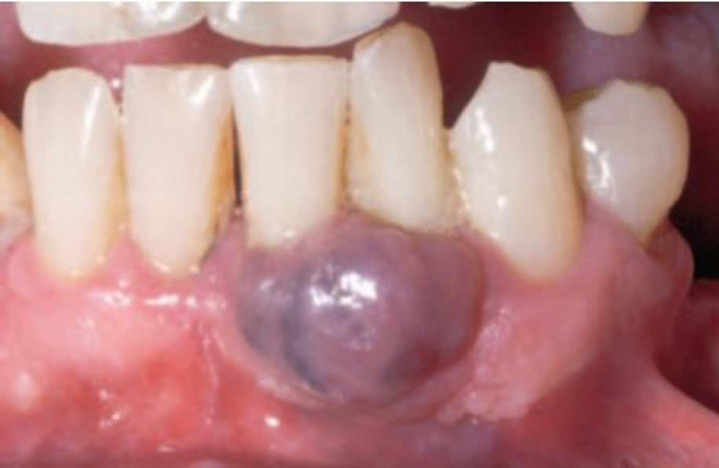 <p>A gingival lesion appears bluish-purple and is firm. Radiographs show cupping resorption of underlying bone.</p><p>What is the most likely diagnosis?</p>