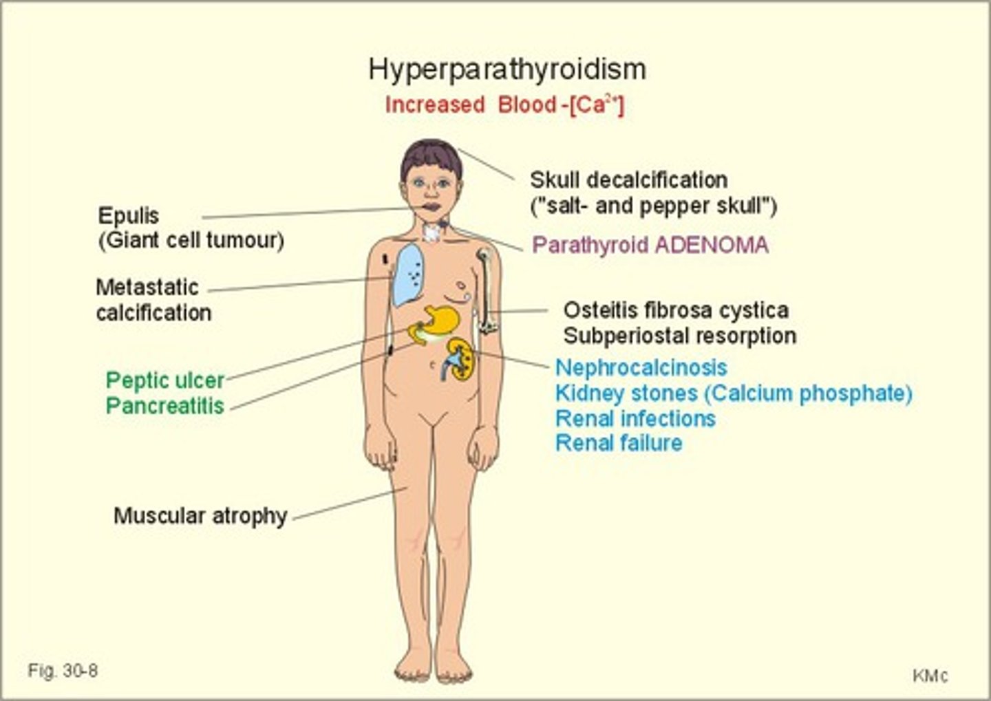 <p>Surgical removal of parathyroid gland</p><p>Medical management includes hydration and ambulation to maintain bone density</p><p>For hypercalcemic crisis, rapid volume expansion with 0.9% NS to treat dehydration and improve glomerular filtration rate; diuretics to increase calcium excretion by the kidneys</p>