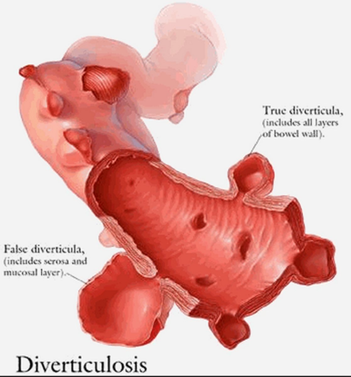 <p>Inflammation in diverticula (pouch-like protrusions in colon). 80% of diverticulosis is asymptomatic, but 20% may progress to diverticulitis. May be a result of low fiber diet.</p><p>Sxs: Abdominal pain, with tenderness over left side of lower abdomen. Cramping, constipation/diarrhea, nausea, fever, chills, vomiting.</p><p>Tx: Diet modification, lower internal colonic pressure through increased fiber. Nasogastric tube for severe cases.</p>