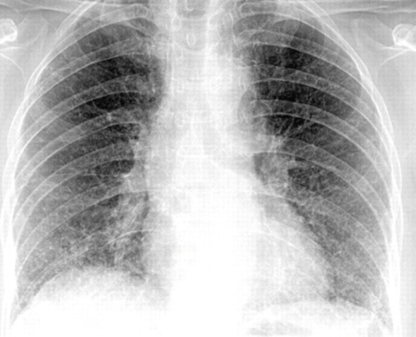 <p>Classic is bilateral diffuse symmetric finely granular opacities/reticular-interstitial airspace disease</p>