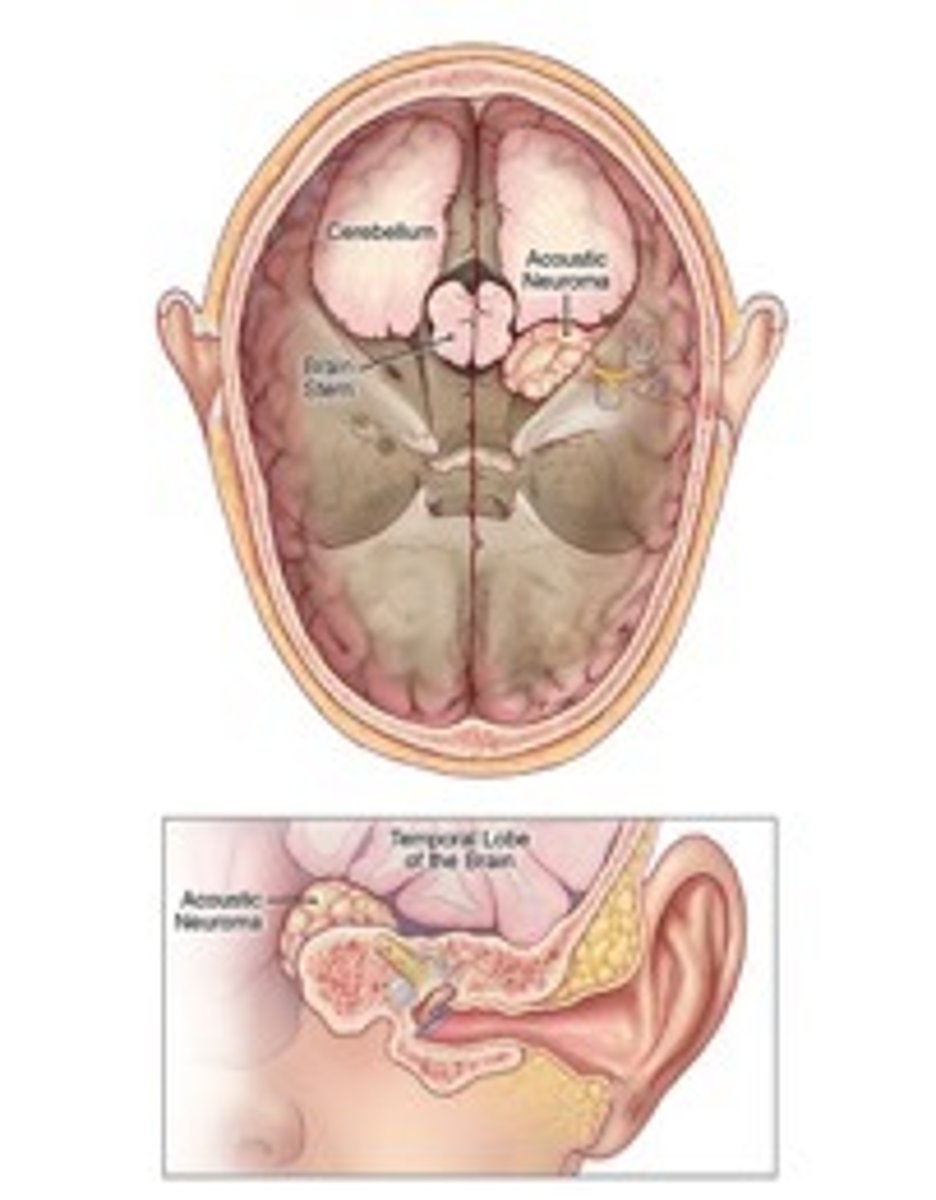 <p>Management is with either surgery, radiotherapy or observation.</p><p>Observation of the tumor can be considered in patients with small tumors or minimal hearing loss, or if they are of advanced age. These patients should undergo MRI surveillance every 6-12 months.</p>