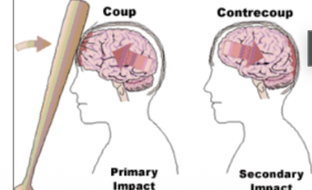 <ul><li><p><span style="line-height: 22.0875px;">Example of one way in which the CSF helps protect the fragile brain tissue&nbsp;&nbsp;</span></p></li><li><p><span style="line-height: 22.0875px;"><strong>Coup-contrecoup refers to the 2 impact type of closed brain injury that results from traumatic impact&nbsp;</strong>&nbsp;</span></p><ul><li><p><span style="line-height: 22.0875px;">First there is the initial impact and direct crushing injury&nbsp;&nbsp;</span></p></li><li><p><span style="line-height: 22.0875px;">A second later comes the secondary impact of the brain against the other side of the skull (when the force knocks the soft brain against the back of the skull)&nbsp;&nbsp;</span></p></li></ul></li><li><p><span style="line-height: 22.0875px;">Closed brain injury without direct trauma: acute acceleration and deceleration&nbsp;&nbsp;</span></p><ul><li><p><span style="line-height: 22.0875px;">Coup-contrecoup injury can also happen even without direct contact to the head&nbsp;&nbsp;</span></p><ul><li><p><span style="line-height: 22.0875px;">Whiplash --&gt; there is no direct impact on the head, but the brain still strikes the inner surface of the cranium&nbsp;</span></p><ul><li><p><span style="line-height: 22.0875px;">In addition, the abrupt acceleration and deceleration causes stretching of the neurons as the brain moves forward and backward inside the cranium: called shear injury&nbsp;&nbsp;</span></p></li><li><p><span style="line-height: 22.0875px;">Shear injury damages and destroys neurons and is a significant component of the morbidity associated with closed brain injuries&nbsp;&nbsp;</span></p></li></ul></li></ul></li></ul></li></ul><p></p>
