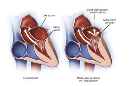 <p>Congenitive Disease; mitral valve cups billow upward → LA during systole</p><ul><li><p>Women</p></li><li><p>Asymptomatic</p></li><li><p>Heart Murmurs</p></li><li><p>Prevent Infective Endocarditis</p></li></ul><p></p>