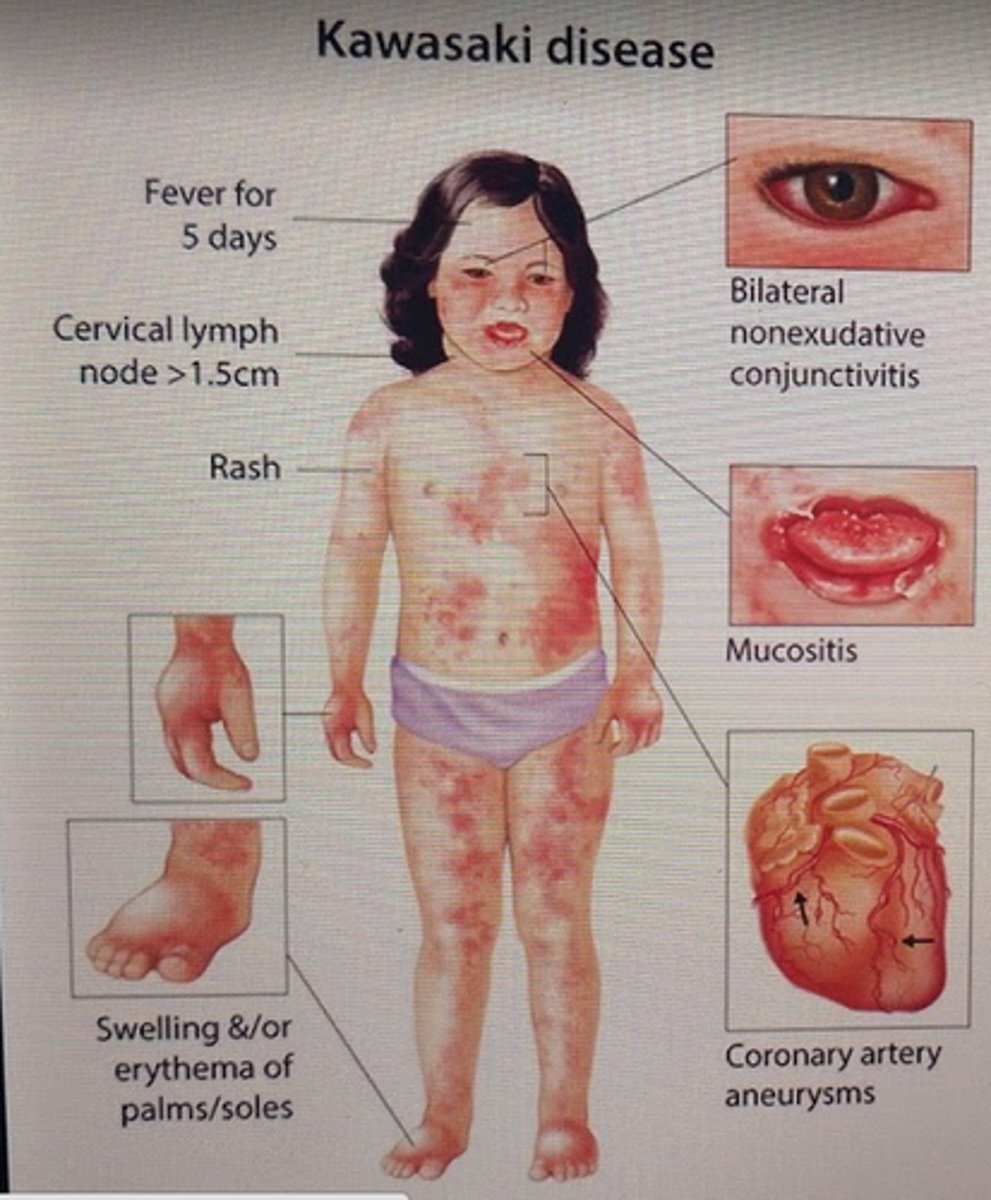 <p>Kawasaki disease (treat with IVIG and aspirin which inhibits TXA2)</p>