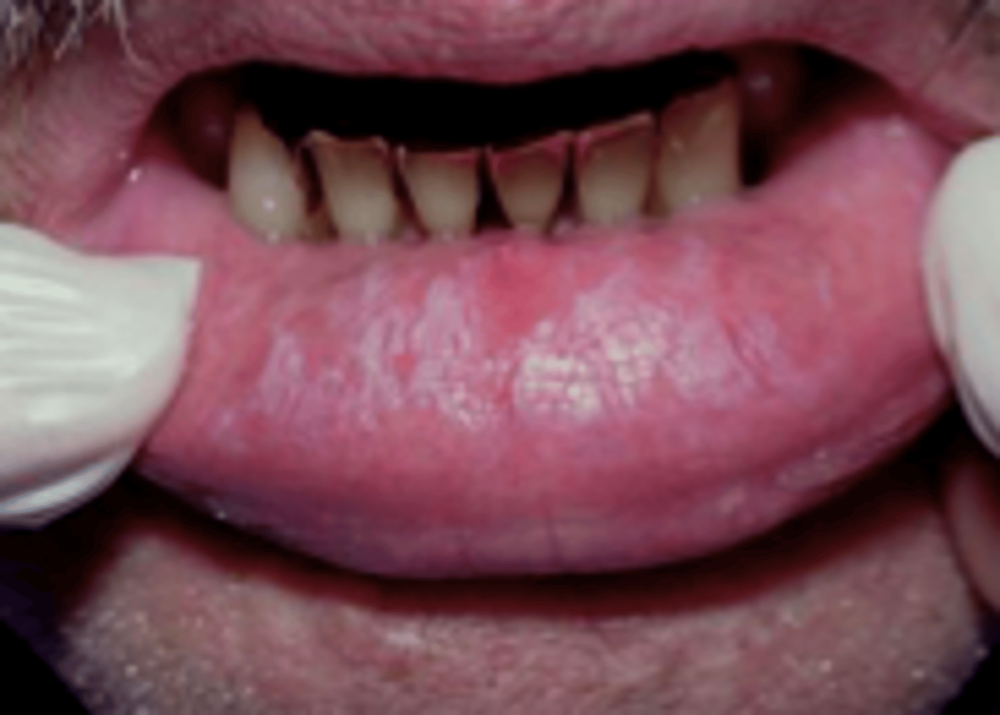 <p>morsicatio buccaratum (chronic)</p>