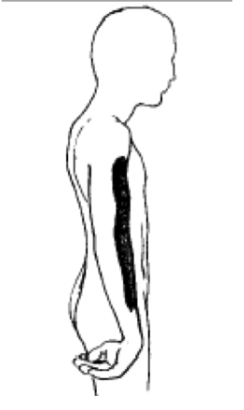 <p>superior brachial plexus injury (injury to C5,C6)</p><p>musculocutaneous, axillary, suprascapular, radial nerves affected</p><p>waiter’s tip position (medially rotated, adducted arm, extended forearm)</p>