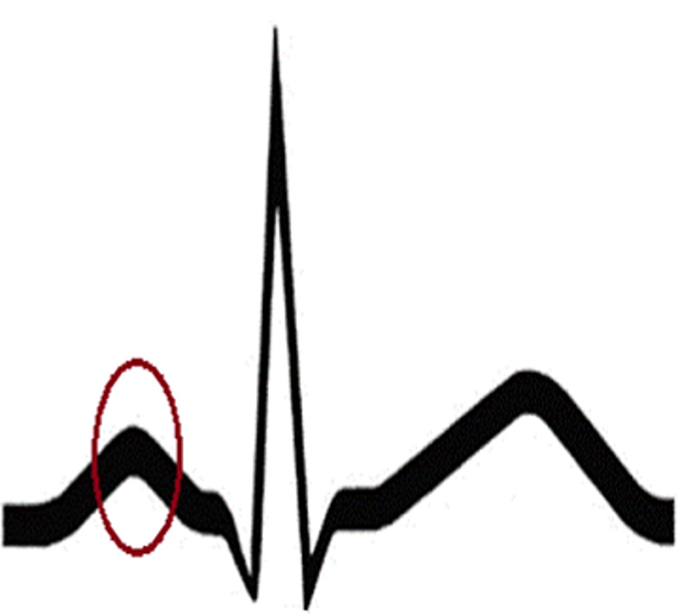 <p>ID the EKG Deflection</p>