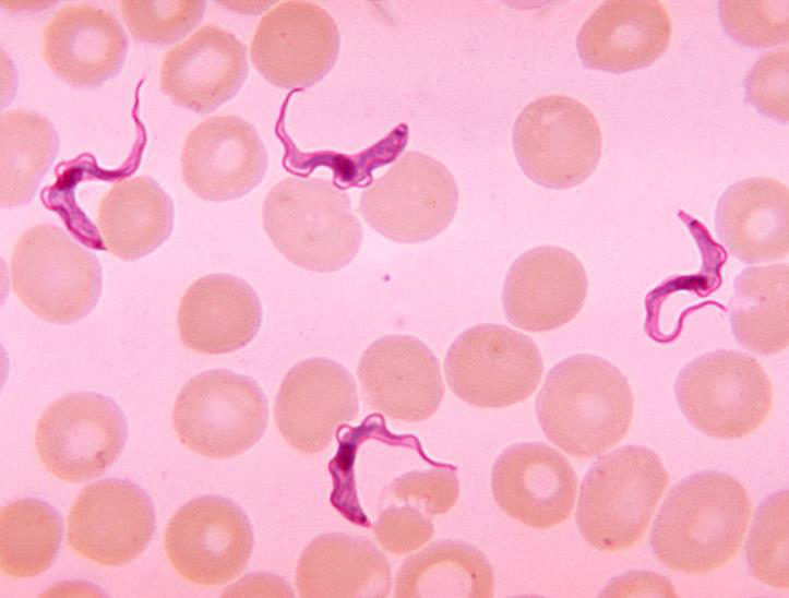 <p><strong>Mention two direct methods for detection of this parasite.</strong></p><ol><li><p><strong>Microscopy:</strong><br>a. Wet mount smears examination to detect trypanosomes’ motility.<br>b. Examination of Giemsa-stained smears to detect the morphological characteristics of polymorphic trypomastigotes.</p></li><li><p><strong>Culture</strong></p></li><li><p><strong>Animal inoculation</strong></p></li></ol><div data-type="horizontalRule"><hr></div><p><strong>How to differentiate between the two species of this parasite? And which antibody can be elevated?</strong></p><ul><li><p>The <strong>card-agglutination test</strong> is used for detection of <em>Trypanosoma brucei gambiense</em> only.</p></li><li><p><strong>High levels of specific antibodies (IgM)</strong> are elevated.</p></li></ul><div data-type="horizontalRule"><hr></div><p><strong>Which parasite species has available card agglutination test?</strong></p><ul><li><p><em>Trypanosoma brucei gambiense</em></p></li></ul><div data-type="horizontalRule"><hr></div><p><strong>Mention two characteristics of CSF in this disease.</strong></p><ul><li><p>Raised pressure</p></li><li><p>Increased cell count (mainly lymphocytes) and protein levels</p></li></ul><p></p>