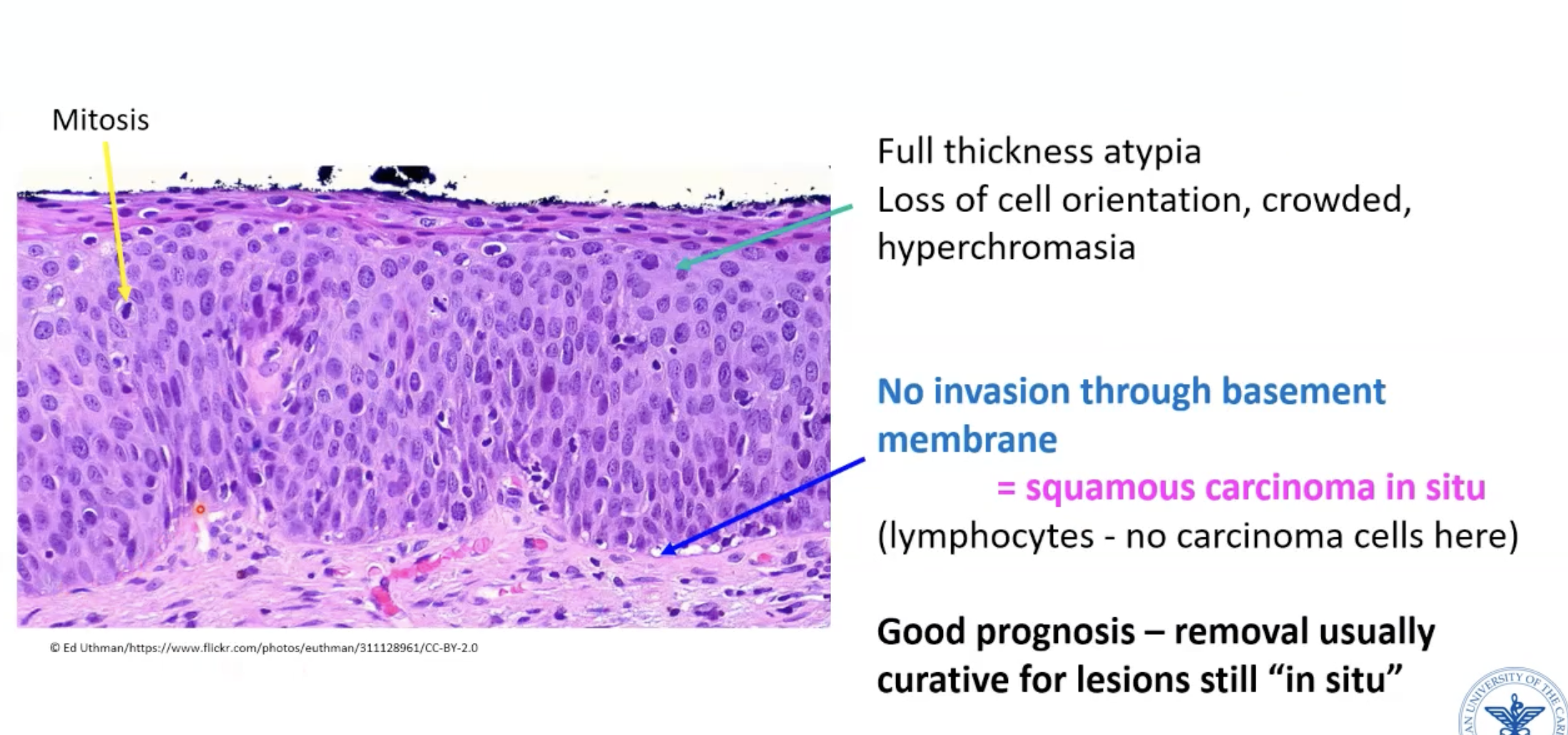 <p>Fully atypical cells from base to apical surface</p>