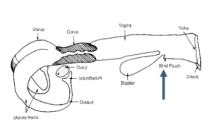 <p>sub-urethral diverticulum</p>