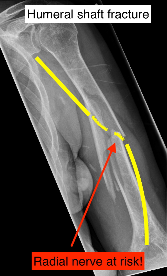 <p>-may cause injury to radial nerve</p><p>-weird exception- humerus fractures often begin with PROM/AAROM while this should be avoided initially with other fractures</p>
