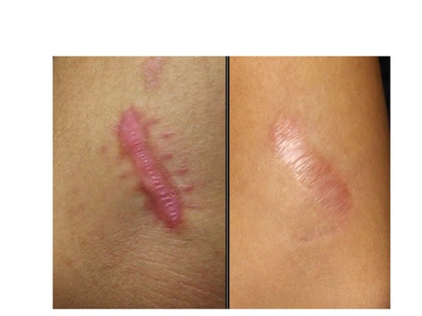 <p>The scar undergoes blanching (losing its red/pink color) and matures from a thickened state to a thinner, smoother appearance. Melanocyte aggregation begins to restore skin pigmentation. </p>