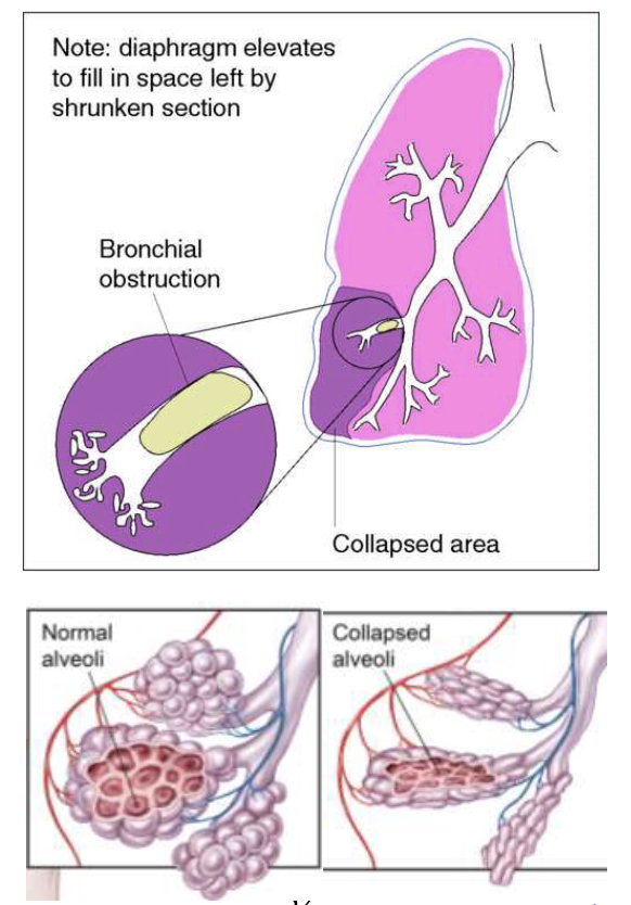 <p>Partial Lobar Obstruction, Abnormal! Collapse of the alveoli due to mucous plug, foreign body or due to surrounding pressure </p><ul><li><p>trachea = may be shifted towards involved side in SEVERE situations </p></li><li><p>tactile fremitus = decreased to absent over the affected area</p></li><li><p>percussion = dull over collapsed airless area only </p></li><li><p>breath sounds = decreased or absent over collapsed airless airleas </p></li><li><p>adventitious sounds = may have wheezes (rhonchi) and crackles depending on severity </p></li></ul><p></p>