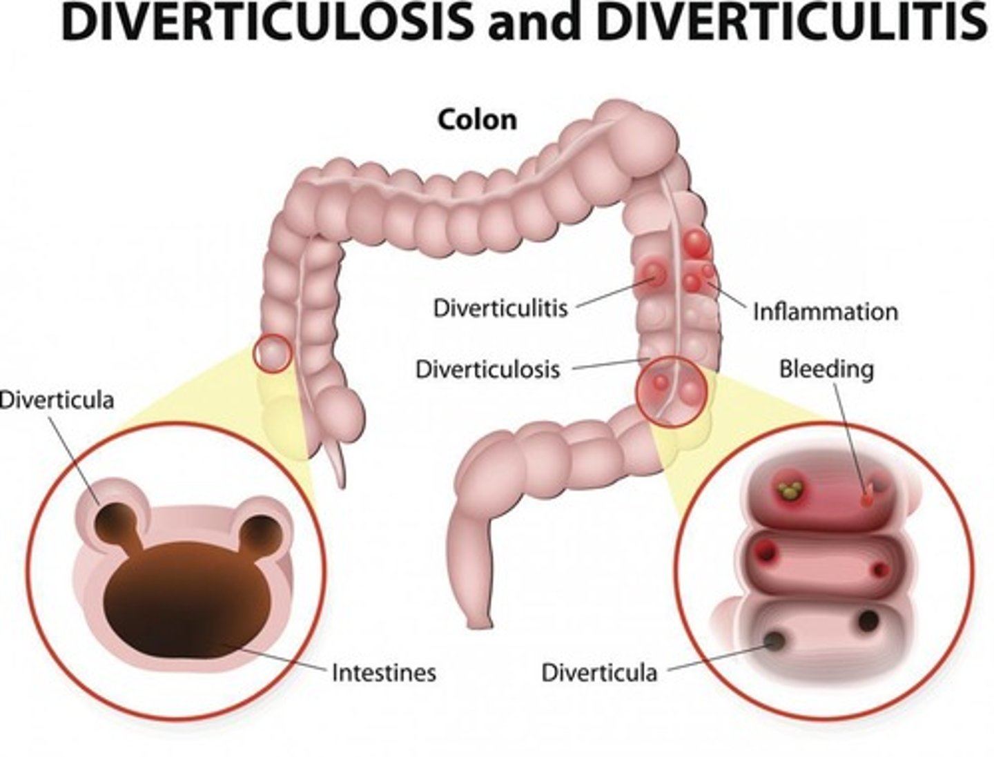 <p>Diverticulosis and Diverticulitis.</p>