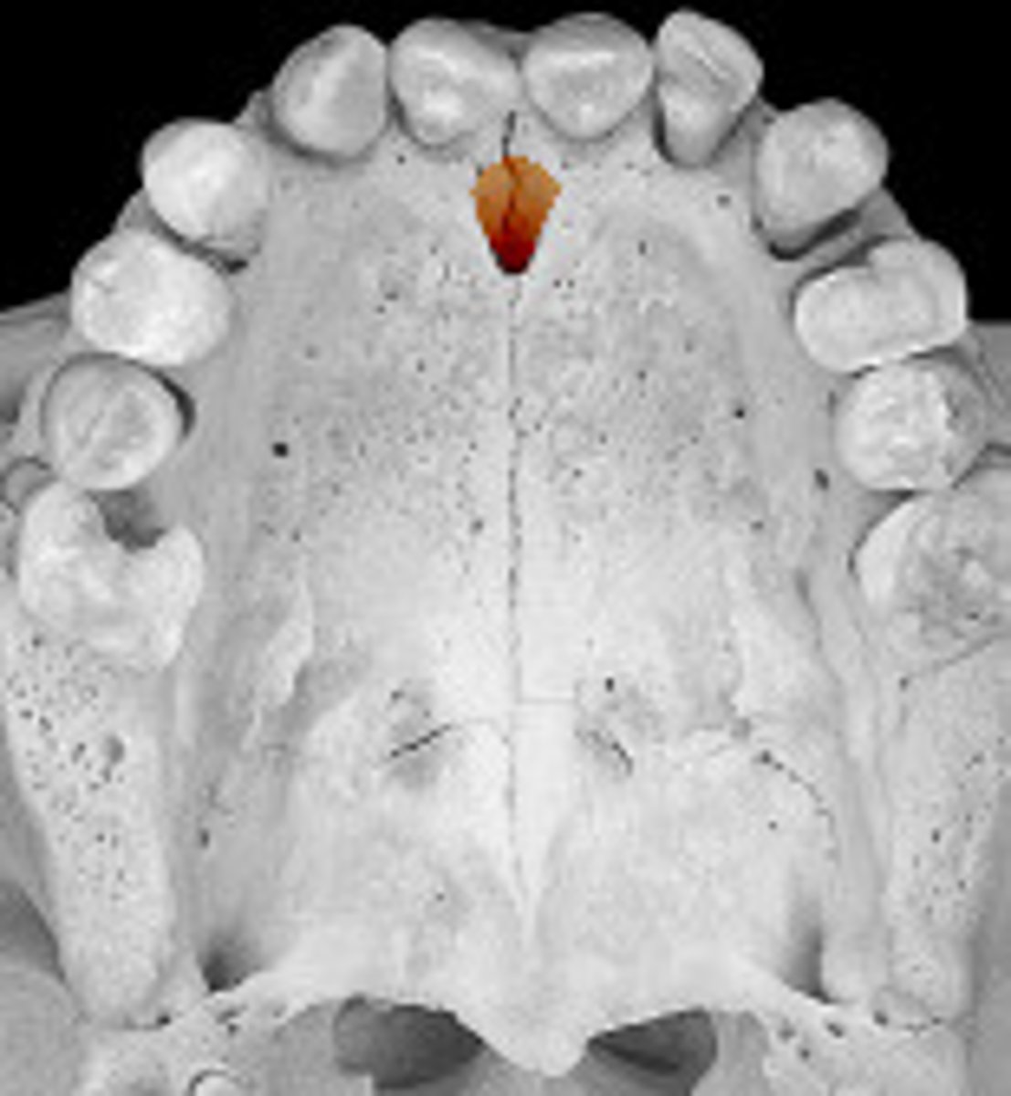 <p>perforated the anterior hard palate at the midline</p>
