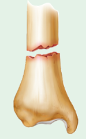 transverse fracture 
