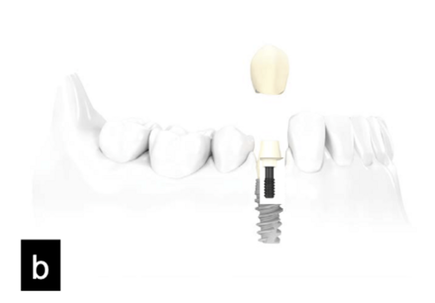 <p>What type of implant does this show?</p>