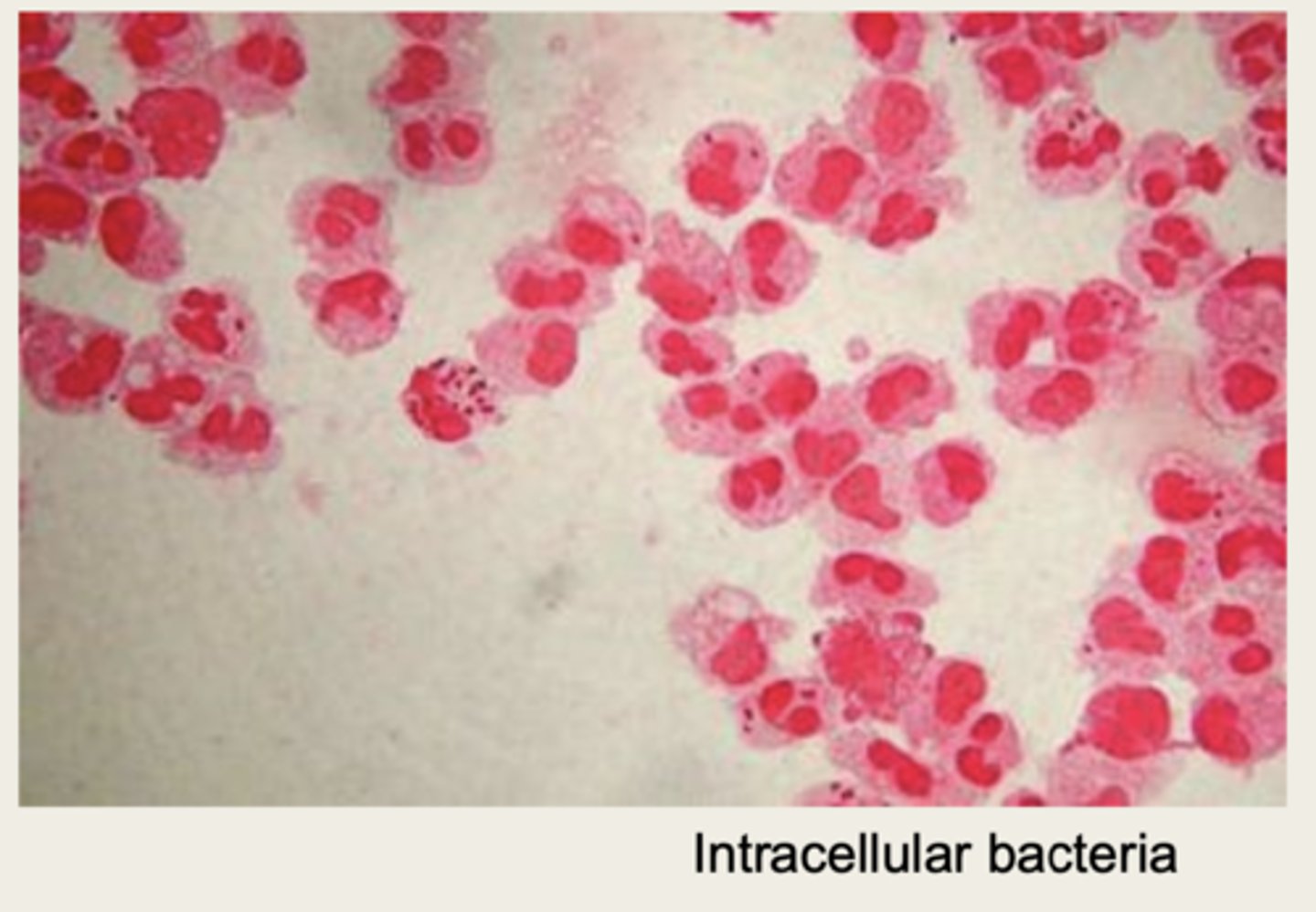 <p>meningococcal meningitis</p>