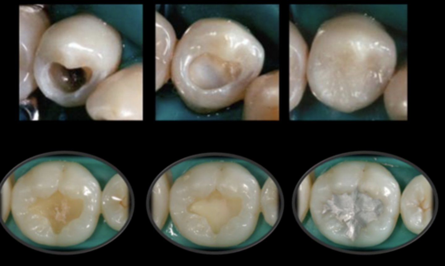 <p>liner</p><p>Gets covered with a final restorative material</p>