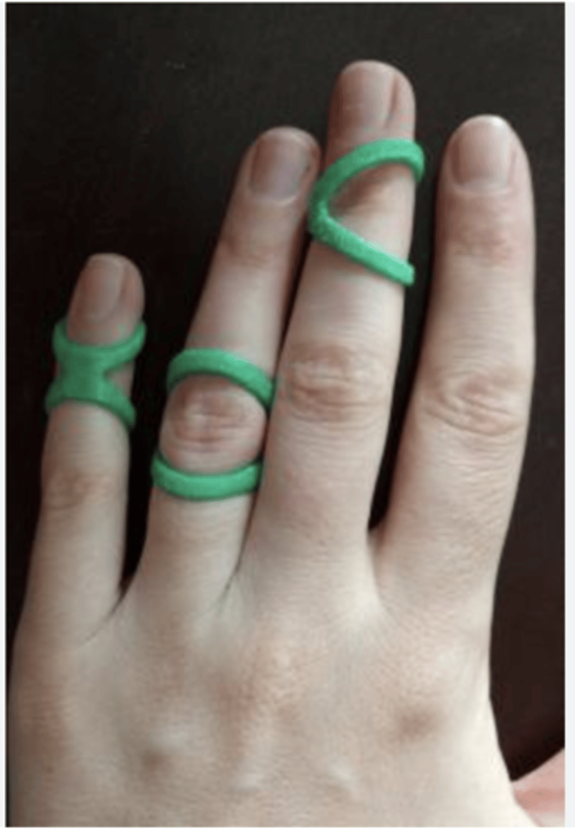 <p>tripod splint</p>