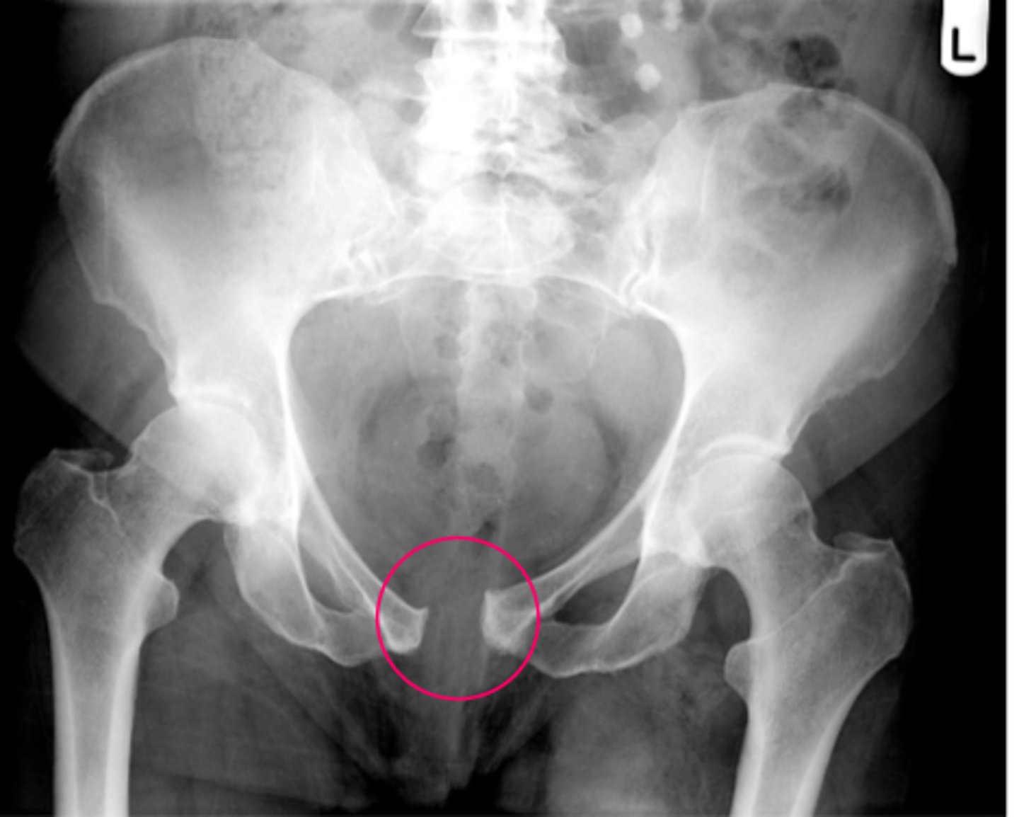 <p>disruption of pubic symphysis</p><p>*type of pelvic fracture</p>