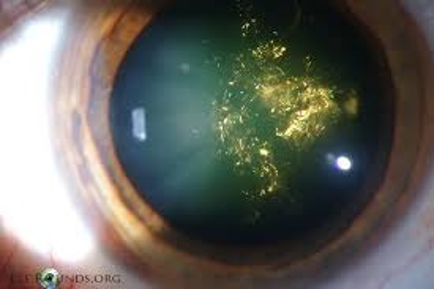 <p>Christmas tree cataract</p>