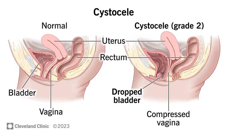 <ul><li><p>weakened upper anterior wall of vagina is no longer able to support weight of urine in bladder</p></li><li><p>bladder protrudes downward into vagina</p></li><li><p>incomplete emptying of bladder</p></li></ul><p></p>