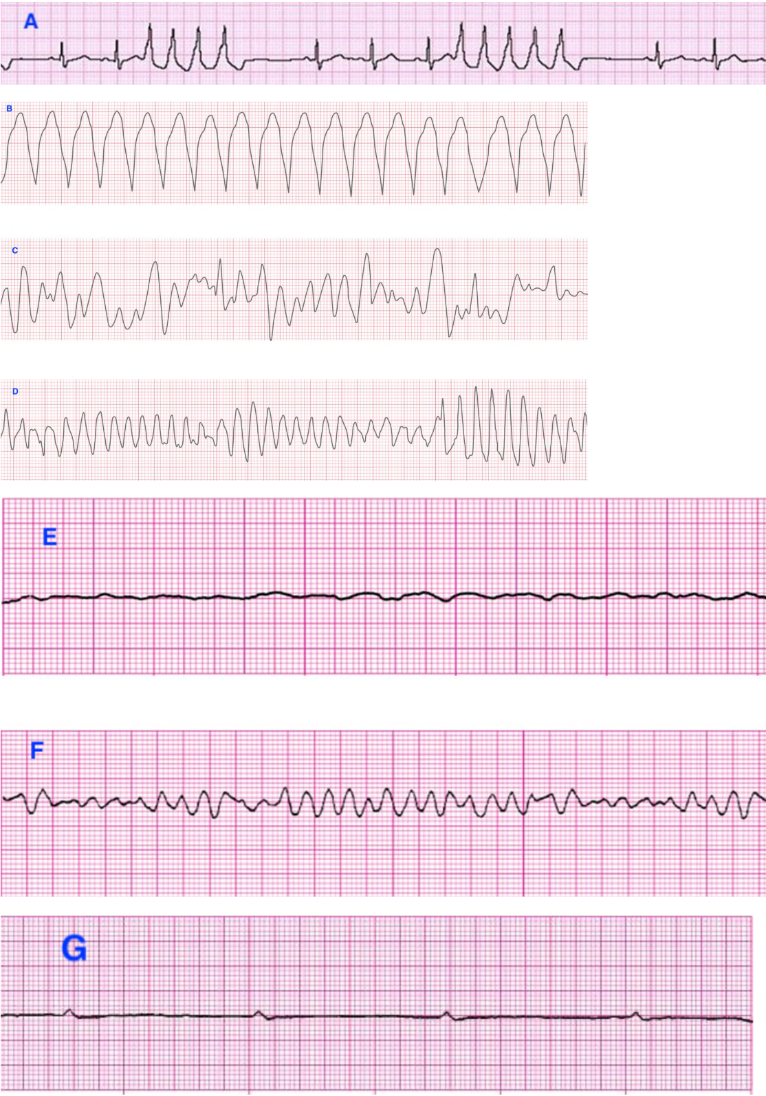 <p><span><span>Match the following ECG strips to the correct ventricular rhythms:</span></span></p>