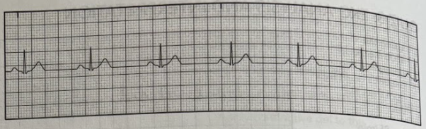 <p>Using the EKG tracing, determine the duration of the <strong>PR interval</strong>.<br>A. 0.08 seconds</p><p>B. 0.12 seconds</p><p>C. 0.2 seconds</p><p>D. 0.28 seconds</p>