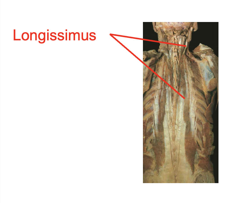 <p>Longissiumus</p><p></p><p>Origin</p><ul><li><p>Transverse process of cervial ant thoractic vertibrea</p></li><li><p>Thoracolumbar aponeurosis</p></li><li><p>liac crest</p></li><li><p>sacrum</p></li></ul><p>Insertion</p><ul><li><p>mastoid process</p></li><li><p>transverse process of cervical and thoractic vertibrea</p></li></ul><p>Action</p><ul><li><p></p></li></ul><p></p>