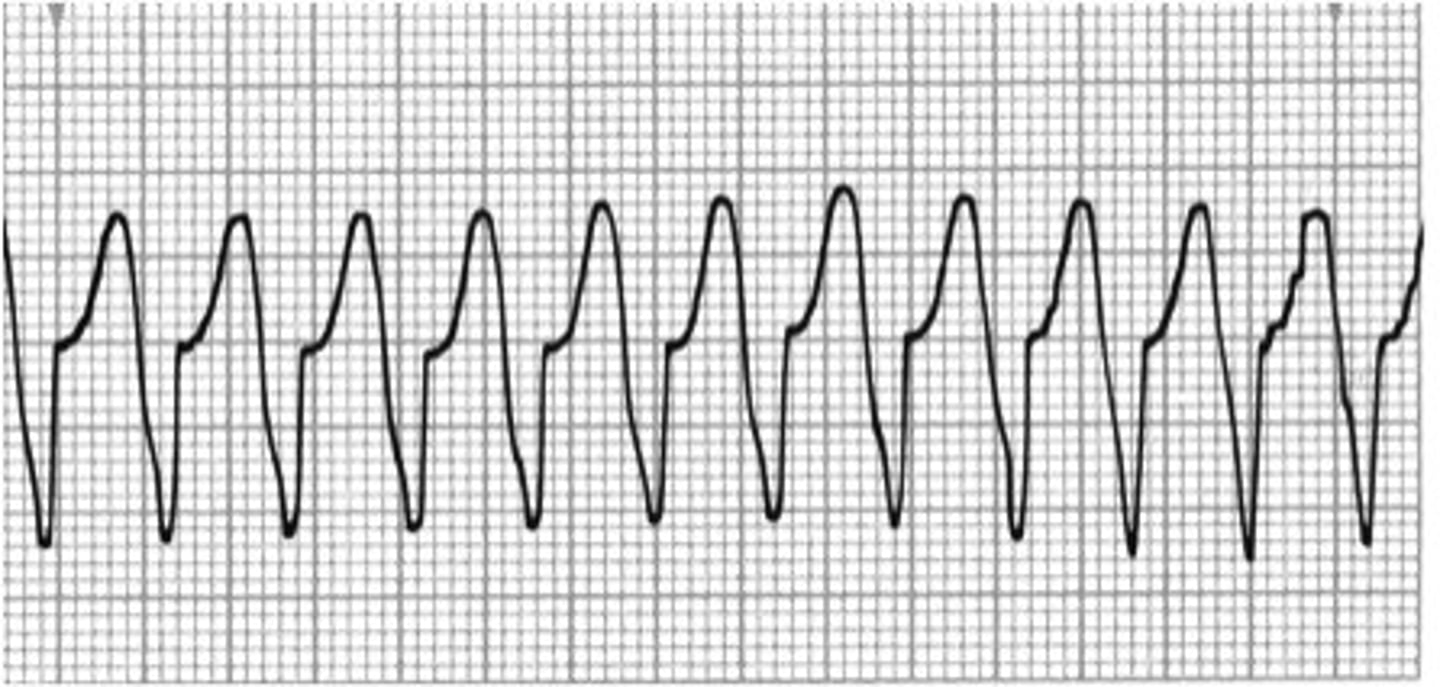 <p>Pulse: Synchronized cardioversion</p><p>Pulseless: Chest compression + defibrillate</p><p>**+/- pulse</p>